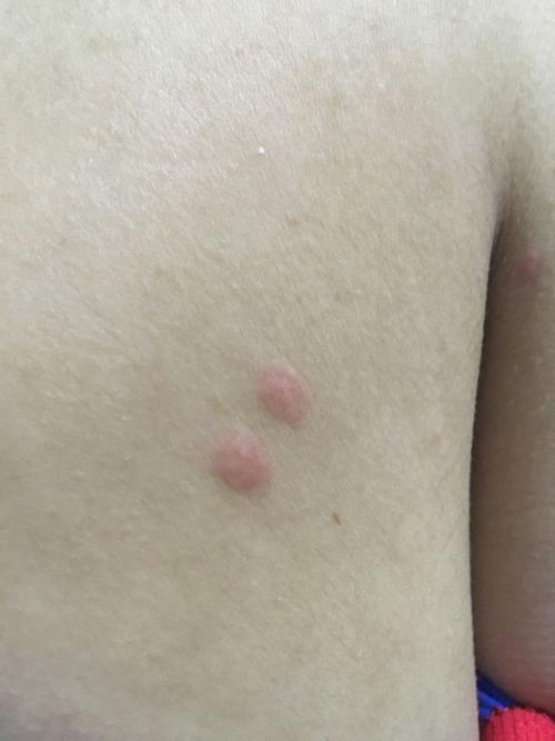 急~急~急.不知道是湿疹还是丘疹性荨麻疹,还是过敏啥的.奇痒无比.