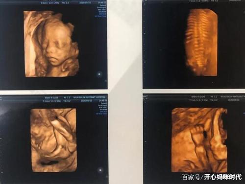 孕期四维彩超主要检查什么?胎儿这些"小秘密",你都发现了吗?