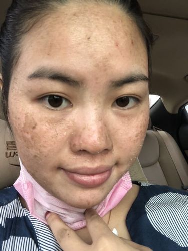 冰冰真皮斑皮肤蜕变过程.独白.