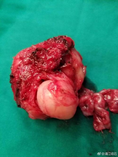 前列腺囊肿怎么办?