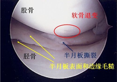 如何拯救退变性半月板撕裂专家的建议