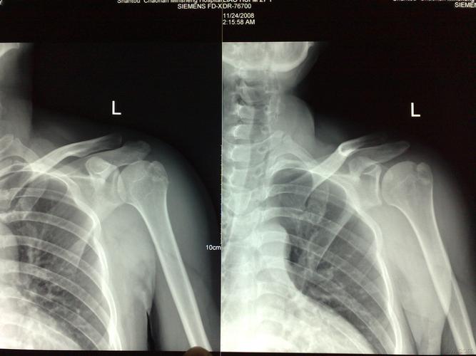 (求助)单纯肩关节脱位复位的技巧