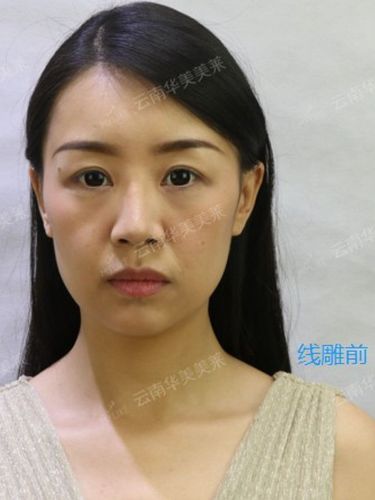 适用于面部松弛下垂,法令纹深,苹果肌下垂,面部轮廓不清晰,有衰老和