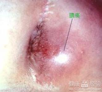 肛门脓肿初期吃药后越来越肿怎么回事呢