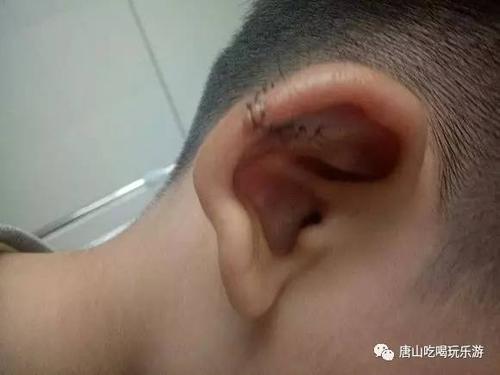 迁安一男孩在幼儿园耳骨骨折学校竟然