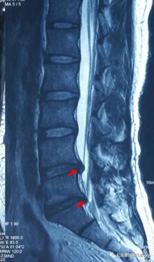 腰椎间盘突出会不会瘫痪