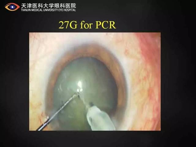 apacrs手术艺术 | 眼前节的27g手术