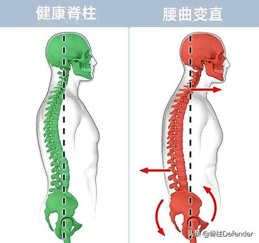 腰椎曲度变直了还有可能恢复吗