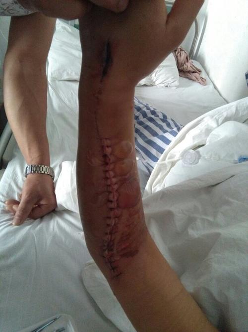 我是工伤,我的胳膊肌肉断了五六块,神经勋伤,现在手伸蜷不行,四肢无力