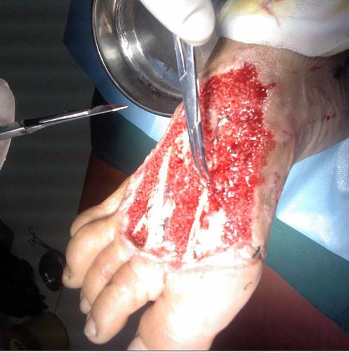 脚面5*6cm皮缺失,现在vsd负压引流三周,改为流沙片,何时植皮最佳?