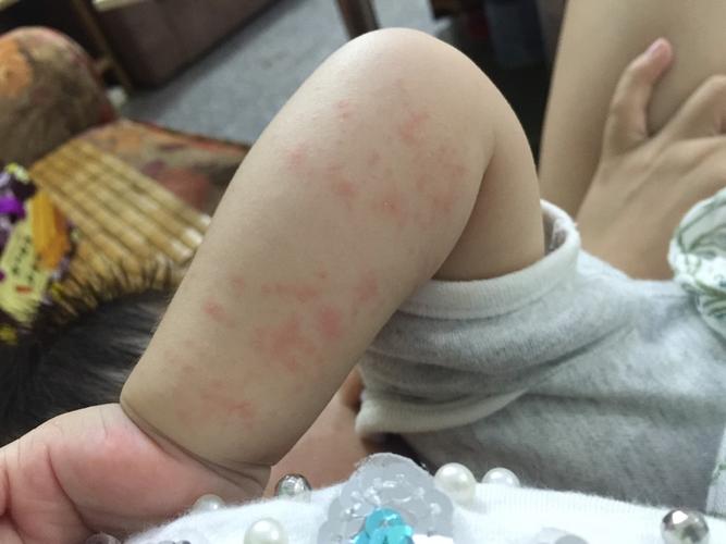 宝宝手臂上长红斑点是怎么回事?