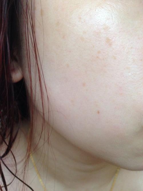 请见图,不知道脸上起的这叫什么斑呀,有没有同样苦恼的朋友