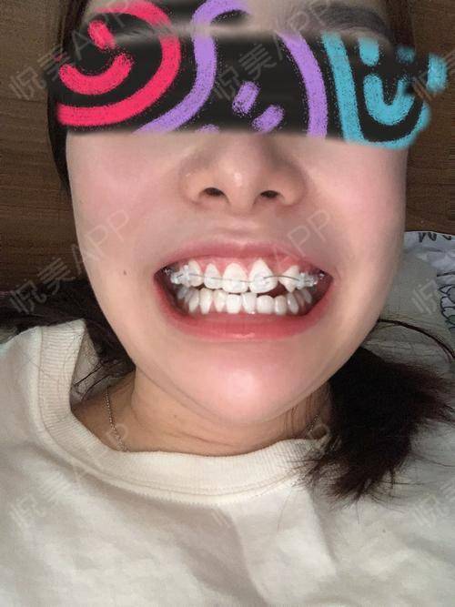 今天戴了上排牙套感觉还是挺神奇的因为是半隐形牙套就没有那么丑嘛