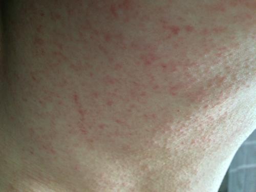 因为在服用肺结核药物引起的皮肤过敏,今天去