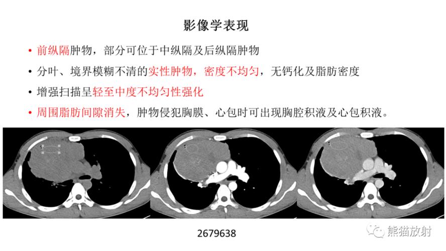 省立影像读片前纵隔肿瘤2109
