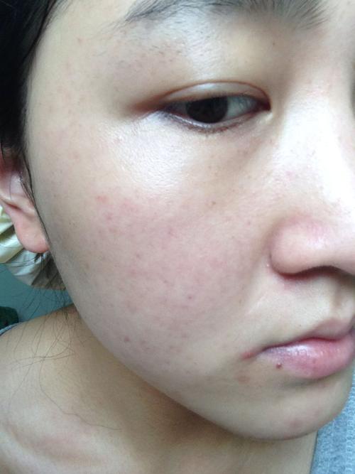 以前长青春痘好了,现在过敏性皮炎,怕会复发,该用什么