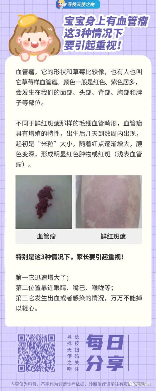 鲜红斑痣是血管瘤吗治疗应该选用激光还是光动力