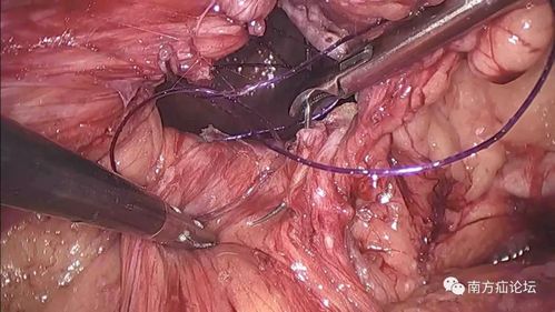讨论|巨大腹股沟阴囊疝(4)