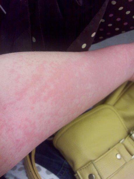 皮肤过敏,症状越来越严重