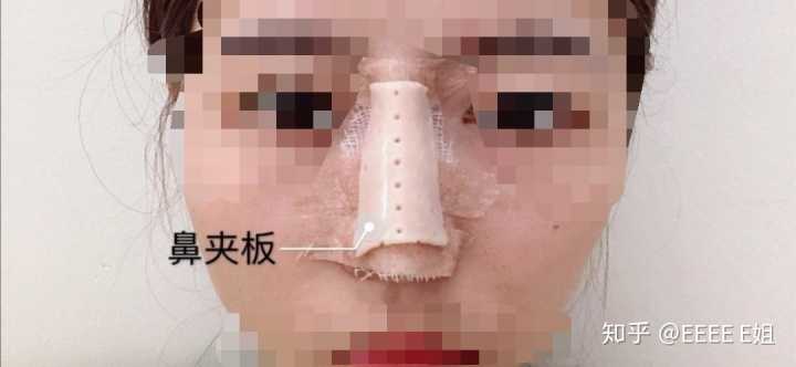 有没有做过鼻骨内推,内切和外切有什么区别啊?