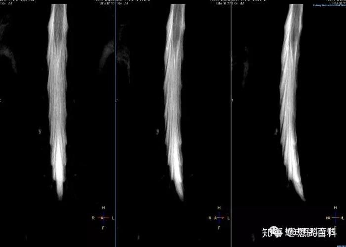 比较多,因为扫描速度比较快,定位也非常简单,以脊髓横轴位为主定位像