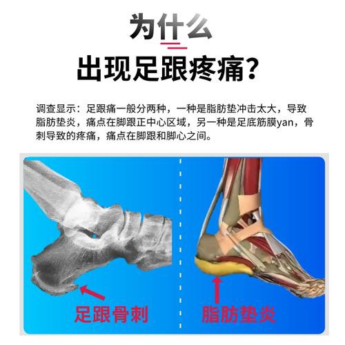 足跟专用骨刺鞋垫脂肪垫炎神器脚后跟疼痛缓解鞋垫