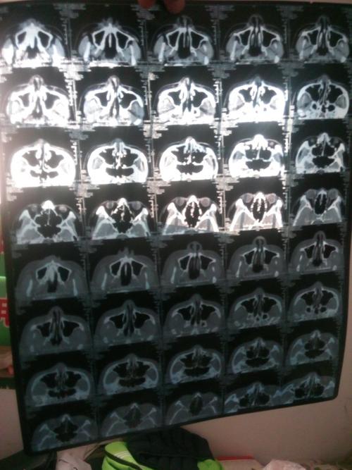 鼻子破开口子,拍片子诊断为:考虑鼻骨骨折,,.,有个考虑这两个字,.