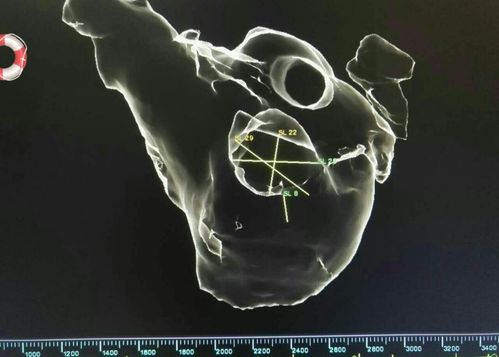 三维系统中显示左房及左心耳结构及大小