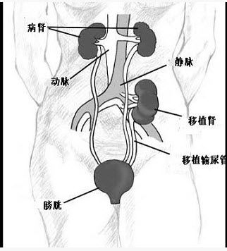 如图,下列有关肾移植麻醉管理的叙述哪项错误()