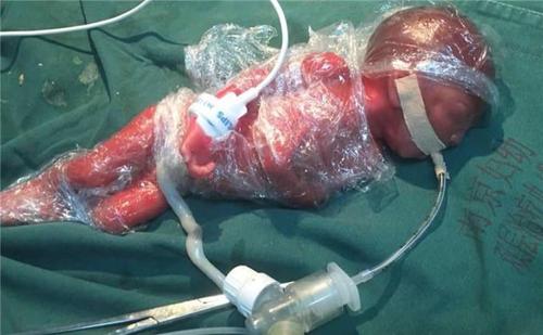 孕妇怀孕22周早产 宝宝只有巴掌大小仅1.1斤重