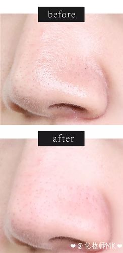 去黑头神器!我的黑头都被吸出来了,画面有点恶心 | 慎