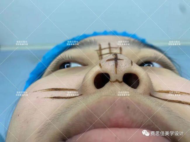 真实记录隆鼻术后3个月这样的妈生鼻也太好看了吧