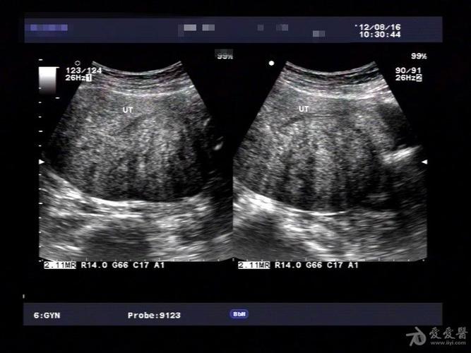 典型病例——子宫腺肌症(一) - 超声医学讨论版 - 医