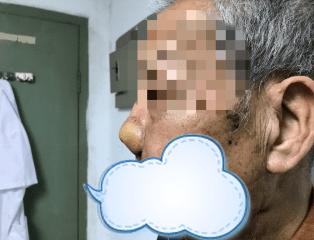 技术分享市一院专家妙手鼻再造恶性肿瘤患者换新颜