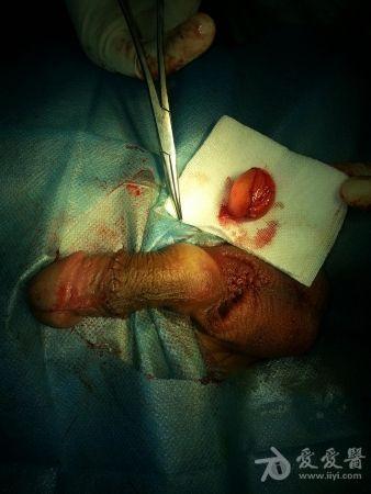 完整剥离的左侧阴囊囊肿