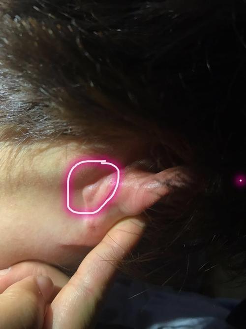 耳朵后面张了个包 硬硬的