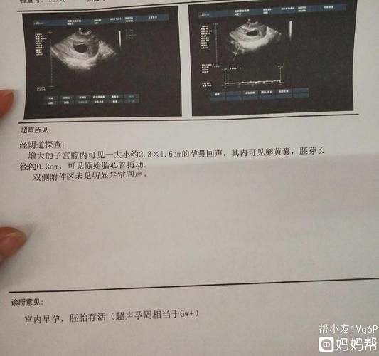 孕6周胎心搏动 男生 女生?有谁看得