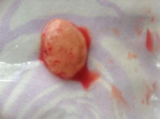 早孕药流排出的孕囊形状图片