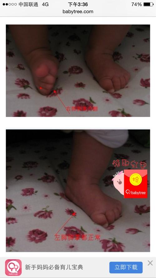 我家宝宝6个月有一只脚站立的时候会内翻怎么办,4个月