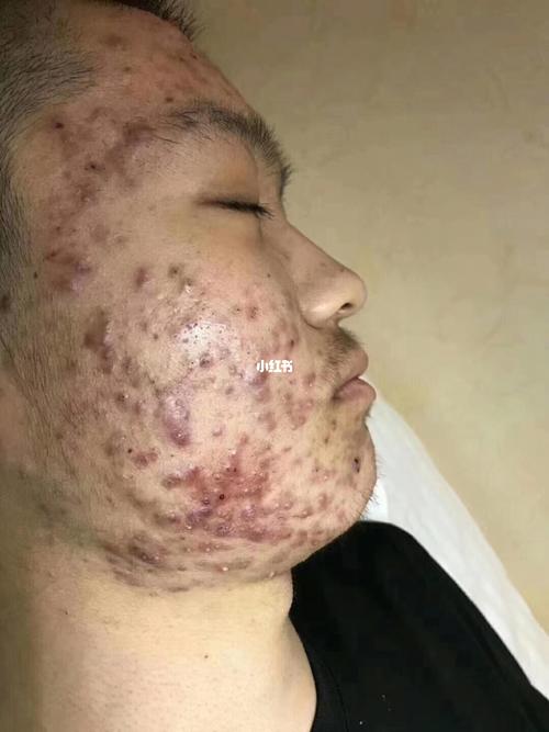 痘痘为什么红肿?