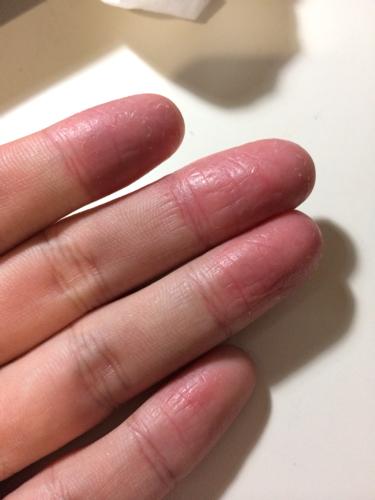 问:手指脱皮之后一直不好还发红,已经持续几个月了怎么办,需要擦点