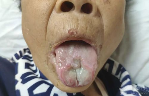 口腔溃疡,白塞氏病