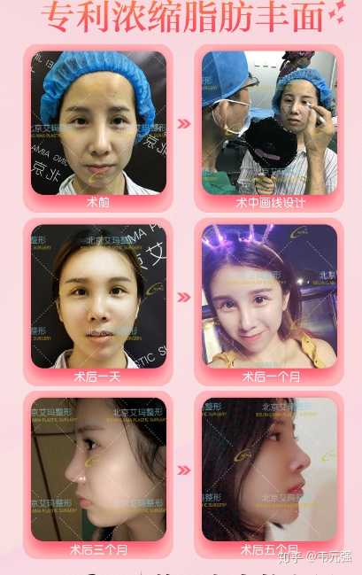 年龄18苹果肌下垂怎么办?