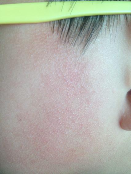 12岁的小孩子脸上长满了一小粒的东西是不