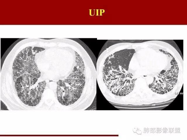 其它 间质性肺炎的分类及简单介绍 写美篇 影像上下结论的时候建议用