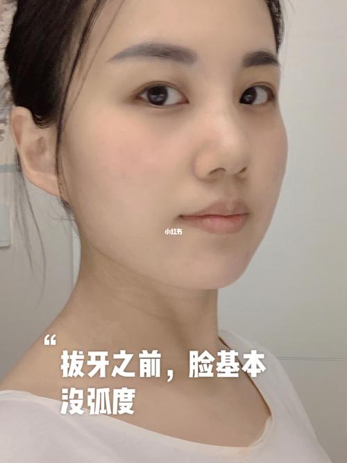 拔歪掉的智齿真的能改变脸型～_脸型_智齿_医疗健康