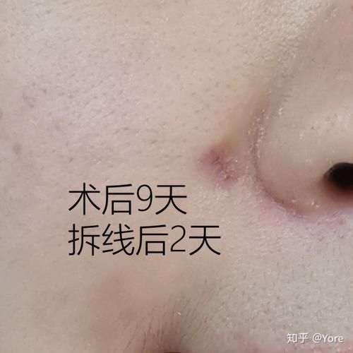 分享我切除脸上色素痣的手术经历