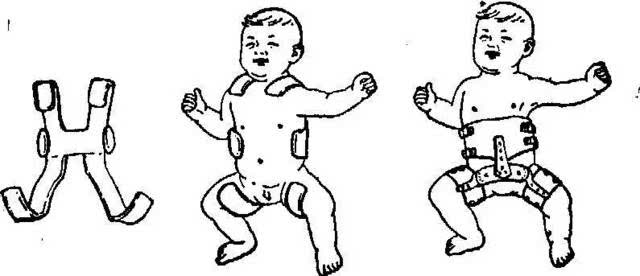 注意新生婴幼儿的"脱胯"!这些小细节您注意到了吗?