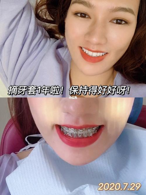 戴保持器也做到好好护理牙齿!