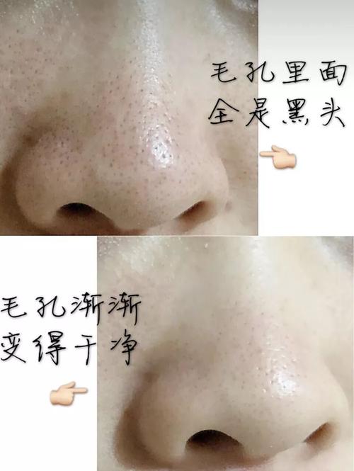 亲测丨又爽又恶心的去黑头方法来了5分钟将陈年黑头连根拔除